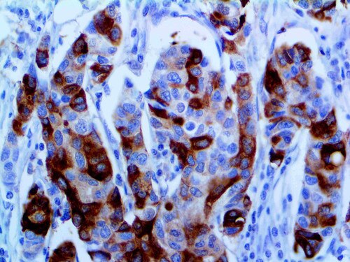 IHC of Mammagloblin on an FFPE Breast Tissue